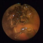 サムネイル：抜管写真