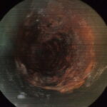 サムネイル：抜管写真