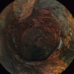 サムネイル：抜管写真