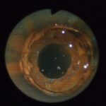 サムネイル：抜管写真